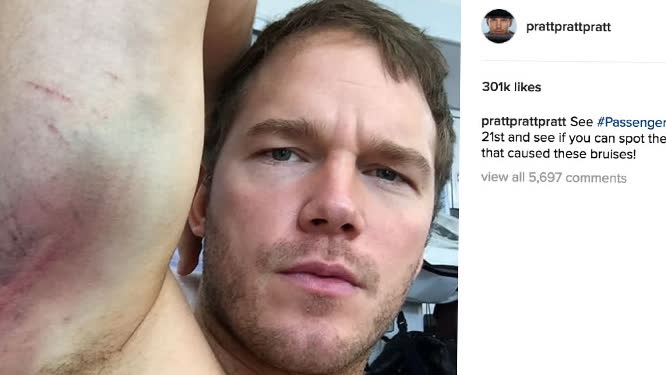 Kolla in Chris Pratts blåmärken