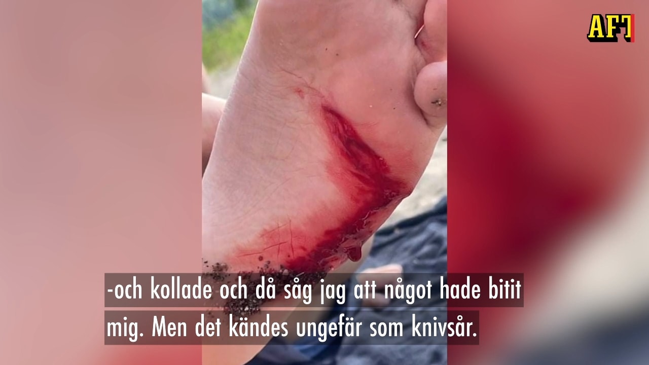 Hör Mathias om bettet: "Kändes som ett knivsår"