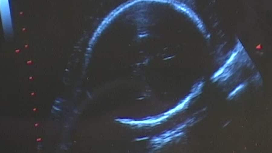 Kosten viktig inför graviditet