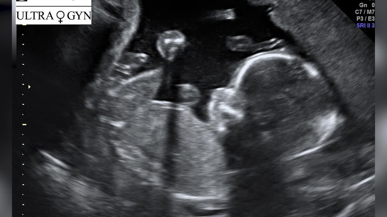 Elsa och Cornelia gör barn – genom insemination