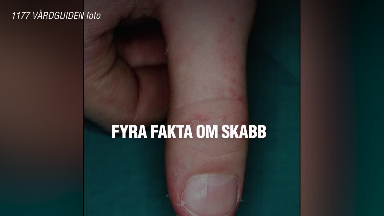 Fyra fakta om skabb