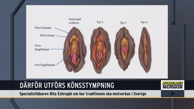 40 000 svenskar kan vara könsstympade