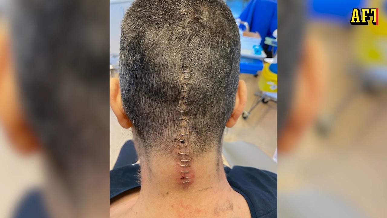 Hjärntumören upptäcktes i sista sekund: "Glad över att jag levde"