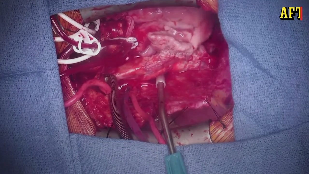 David, 57, är den första att få ett grishjärta inopererat och överleva: "Det är min sista chans"