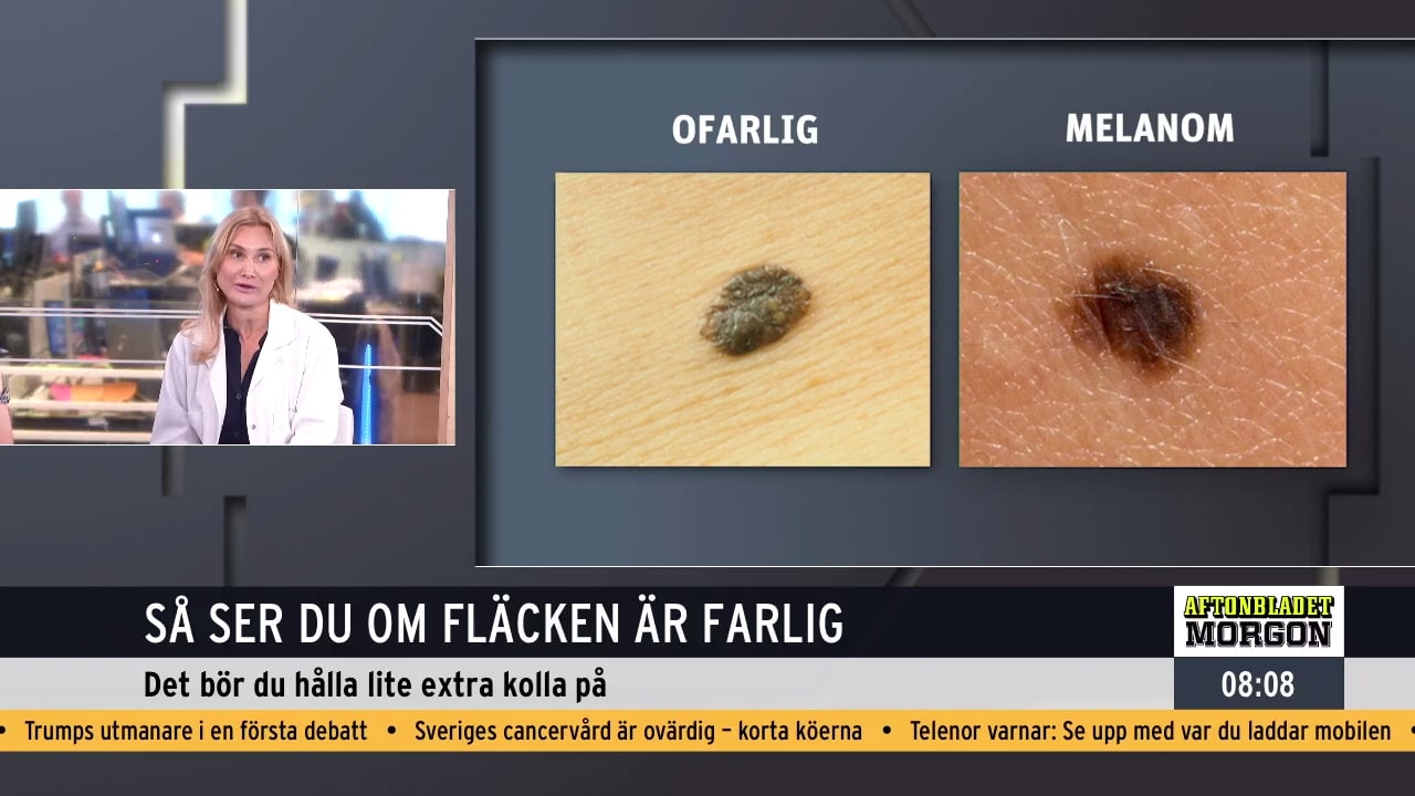 Så ser du om fläcken är farlig: "Mindre än en millimeter"