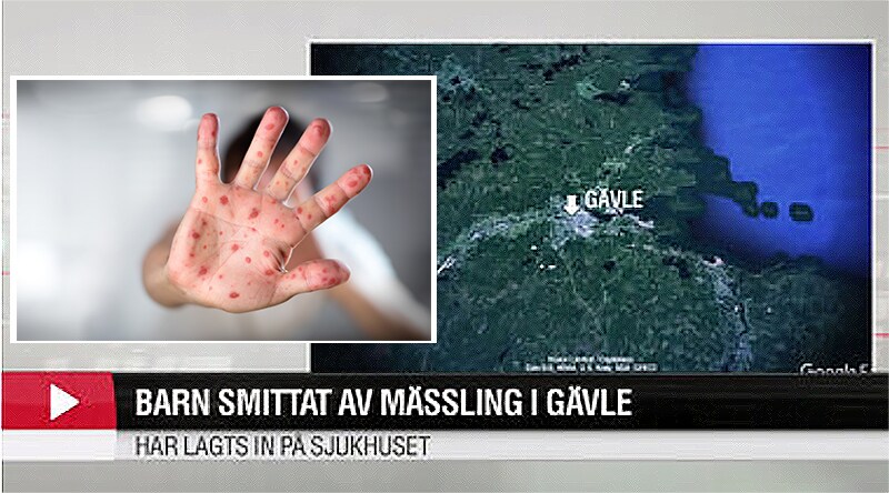 Larm om mässlingsmitta – ett barn inlagt på sjukhus