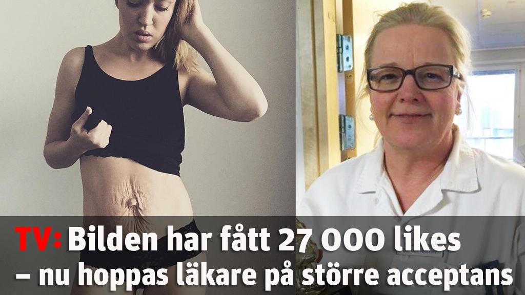 Efter Josefines bild - läkare hoppas på större acceptans