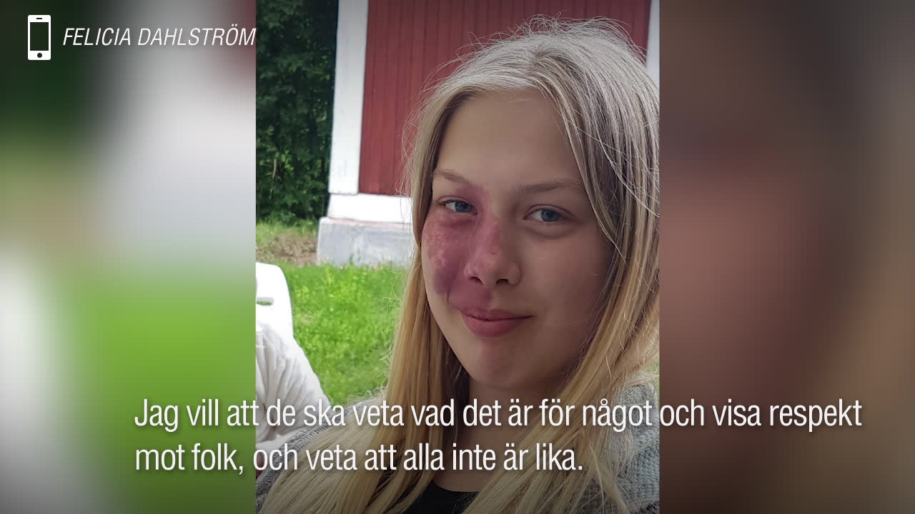 Felicia, 15, mobbas för sitt utseende – nu har hon fått nog