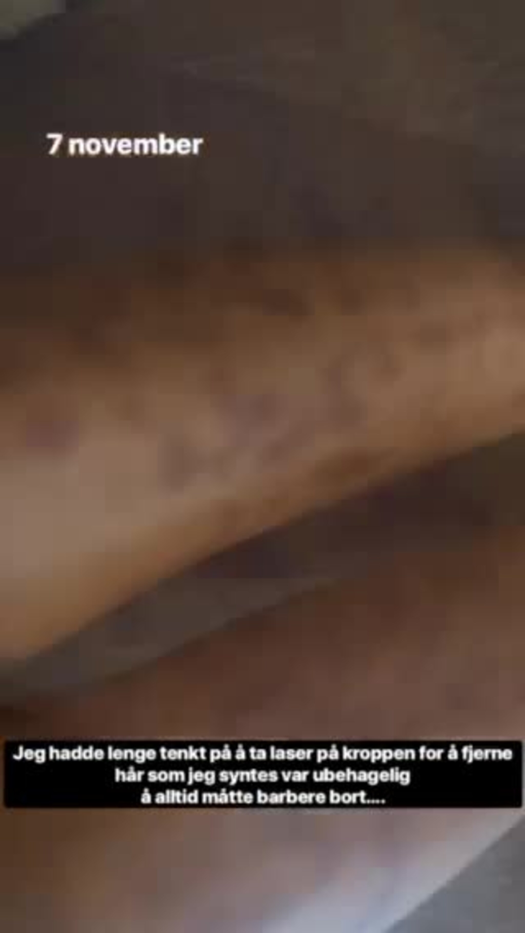 Slik så Elisabeth ut etter laserbehandling